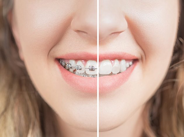 Someone before and after braces