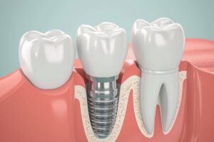 3D rendering of a dental implant between 2 other teeth
