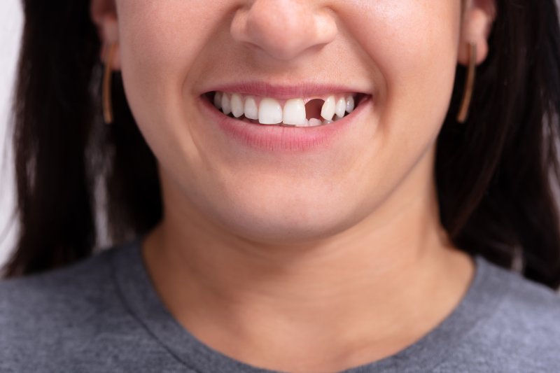 Patient smiling with a missing front tooth waiting for dental implants